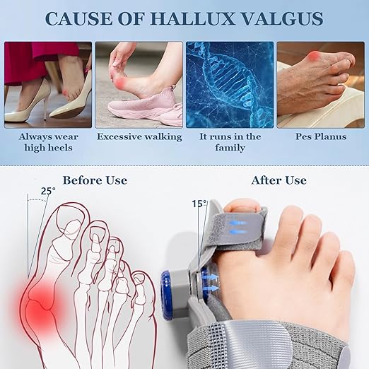 Bunion Corrector